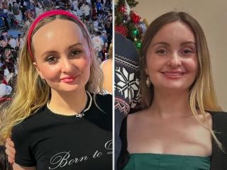 تصاویر قبل و بعد از عمل‌های زیبایی بیمارانی که از نتایج عمل بسیار راضی بودند - ۱