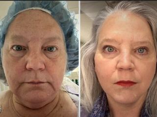 تصاویر قبل و بعد از عمل‌های زیبایی بیمارانی که از نتایج عمل بسیار راضی بودند - ۲