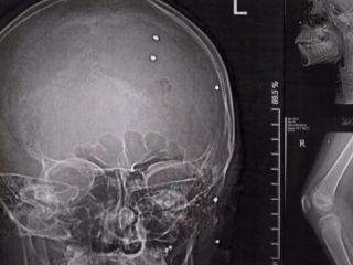 مجله نیویورکر گزارشی از «شرایط آخرالزمانی» در مراکز درمانی ایران پس از سرکوب اعتراضات ارائه داد