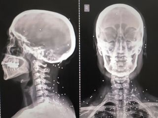 گزارش گاردین از هدف‌گیری عمدی اعضای حیاتی بدن برای سرکوب معترضان در ایران